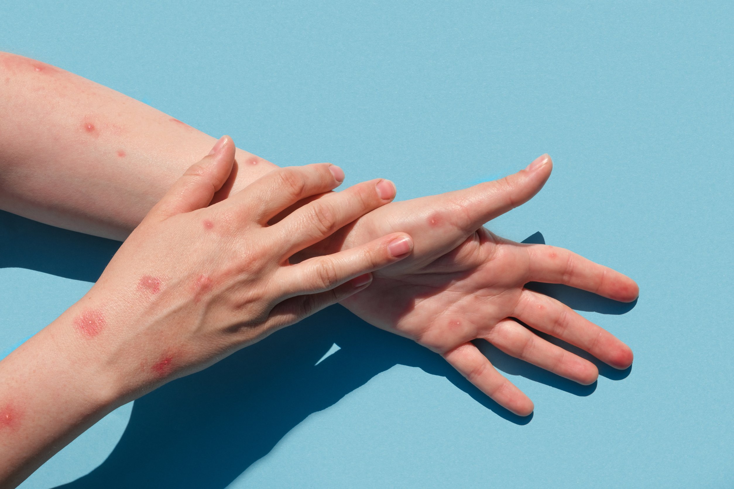 U.S. Declares Monkeypox a National Health Emergency